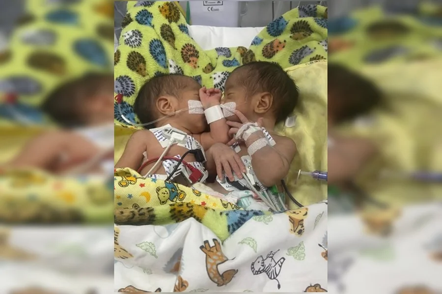 Gêmeos unidos pelo abdômen morreram 4 dias antes de cirurgia em Goiás