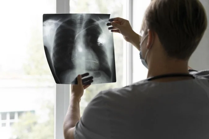 Nova tecnologia promete acelerar tratamento do câncer de pulmão