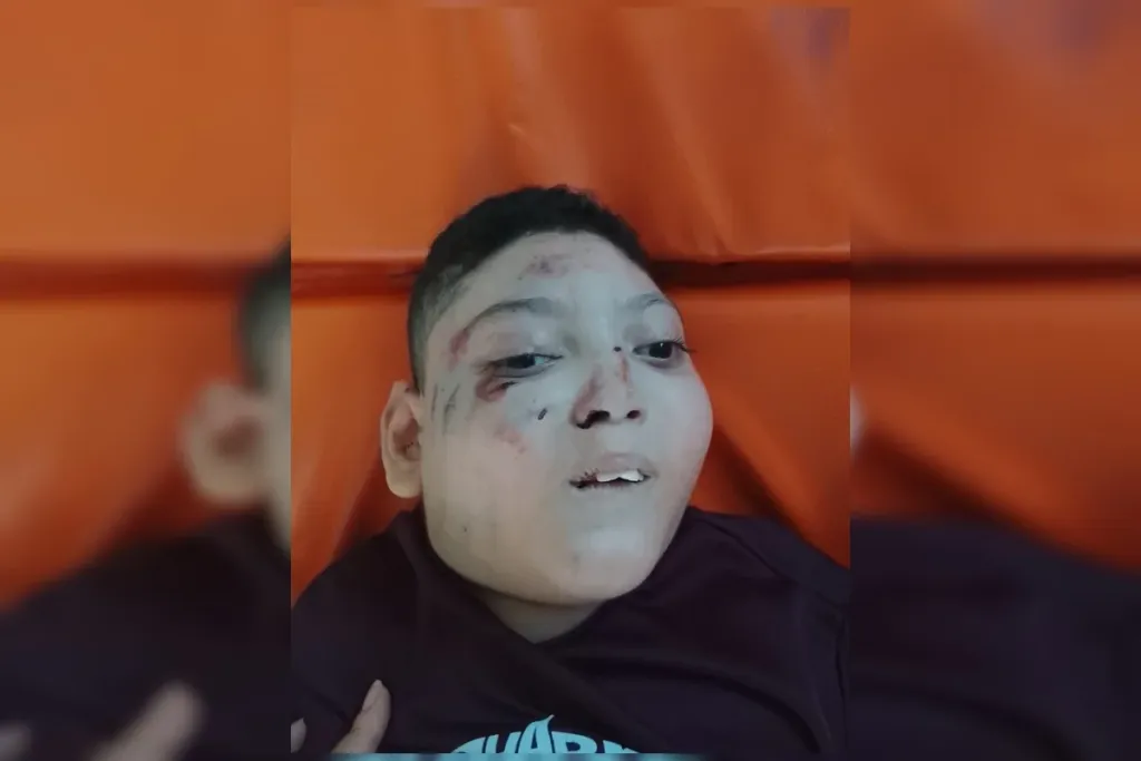 Menino cadeirante fica ferido após cair de escada rolante em estação do Metrô-DF